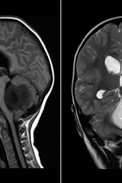 analisis-de-intervencion-interdisciplinaria-en-ninos-con-tumor-de-la-fosa-posterior.jpg