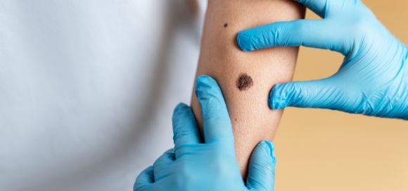 Melanoma: el tipo de cáncer de piel con mayor mortalidad en las personas