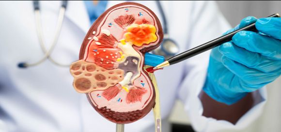 La Enfermedad Renal Crónica y las siete reglas de oro para prevenirla